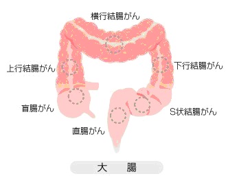 癌 s 状 結腸