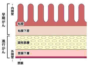 分類 ボール マン 直腸癌なのにボールマン2型って？？ポリープの分類でY